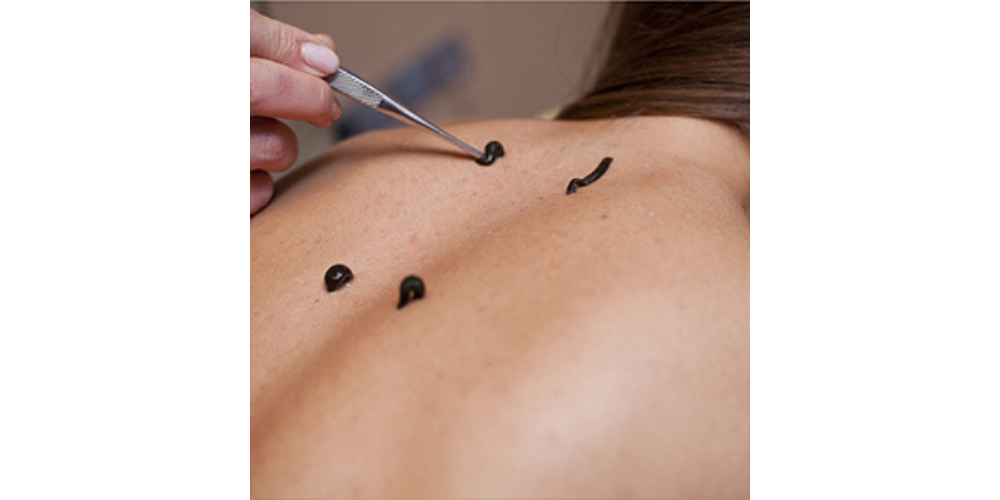 BLOOD LETTING THERAPY (RAKTAMOKSHANM)