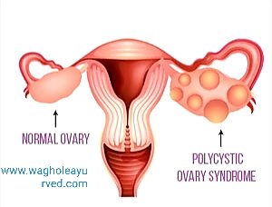 PCOD / PCOS And Ayurveda