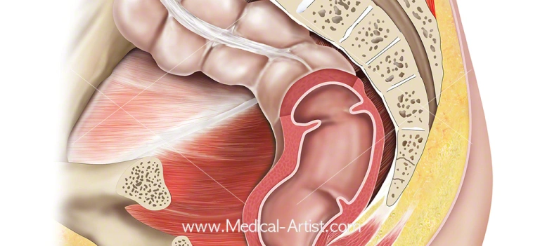 Piles (Hemorrhoids), Fissure , An Anal Fistula