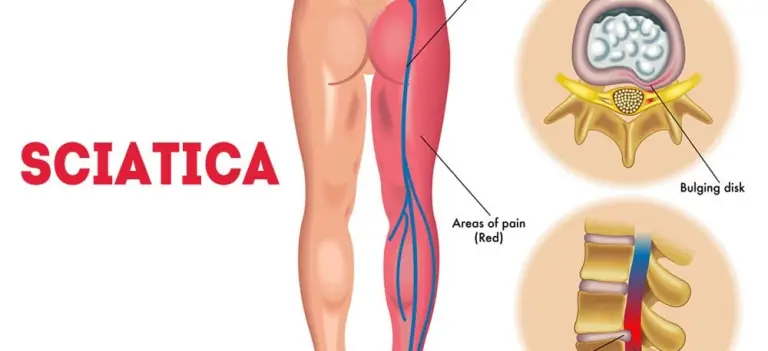 Sciatica And Ayurveda Treatment